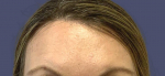 Botox 4 After